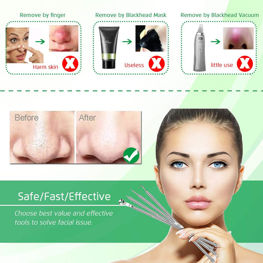5PCS Blackhead Remover Comedone Extractor, Curved Blackhead Tweezers Kit, Professional Stainless Pimple Acne Blemish Rem