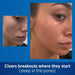 Acne Treatment Differin Gel, 30 Day Supply, Retinoid Treatment for Face with 0.1% Adapalene, Gentle Skin Care for Acne Prone Sensitive Skin, 15G Tube (Packaging May V